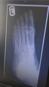 X-ray from six weeks ago - fifth metatarsal fracture clearly visible